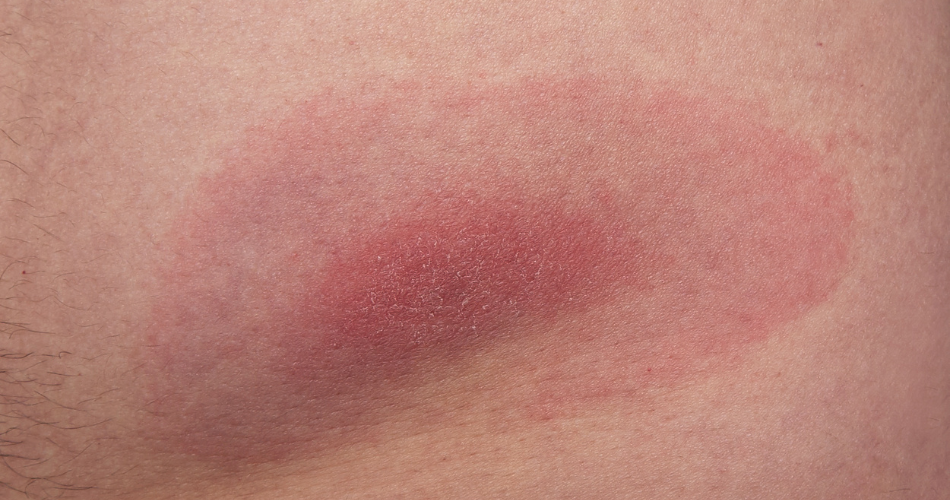 Lyme borreliosis from a tick bite